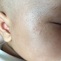 有没有宝妈知道宝宝脸上这是什么？这是前两天出来的，然后越来越多，脸上都有了，宝宝不热不用力就没有...