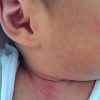 宝宝今天十二天了，今天发现宝宝脖子下面长三颗红点点，各位宝妈帮我看看，这是什么？