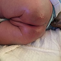 宝宝屁股长几个小颗粒，宝妈们推荐擦什么呢，我擦红霉素软膏2天了