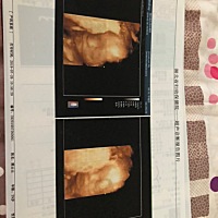 猜男女！四维检查胎盘位置低，不开心。