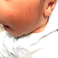 宝妈们看看这种小疙瘩怎么办