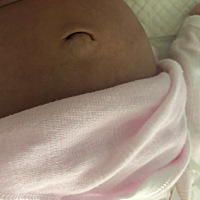 宝宝26天肚脐有个包包，一直都是这样，这个正常吗