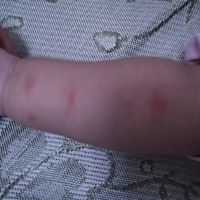 这是什么原因啊   手按下去没有  一松手就有  皮一拉紧也没  松手就有  下午起的  不知道是不是蚊子的  ...