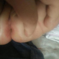 宝宝屁股红成这样，宝妈们有什么办法吗？求助！