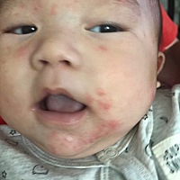 谁可以帮我看看宝宝脸怎么了吗，6个月多月了，总是反反复复，湿疹膏也用了不少，一热起来，脸就这样，只...