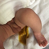 宝宝15天，纯母乳喂养，拉屎次数多，拉的有点稀，需要服用益生菌吗