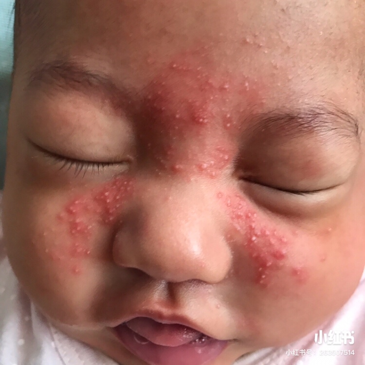 医生说是新生儿痤疮 跑了好几家医院 也拿了好多药膏 就是不见好 还越来越红 该怎么办 看见儿子的脸 我真心疼.大家有没有遇到这样的d