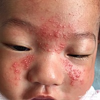 医生说是新生儿痤疮 跑了好几家医院 也拿了好多药膏 就是不见好 还越来越红 该怎么办 看见儿子的脸 我真...