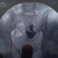 医生说我输卵管堵塞，麻烦能看懂的姐妹帮我看看