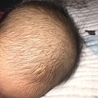 宝宝55天了，最近发现卤门附近长了一个脓包样的结痂，不知道是啥，该如何处理？