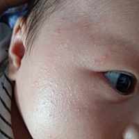宝宝脸上脖子长了好多痘痘，尤其一热就红的比较明显。宝妈有知道怎么回事吗？
