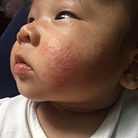 问下各位宝妈这是不是湿疹还是过敏  反反复复的  有时好了又会长出来 老是红红的 洗菊花水和艾叶草都没...