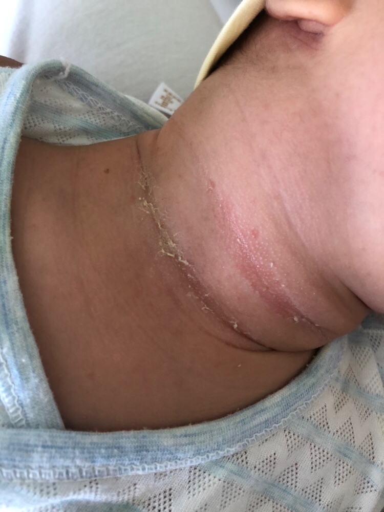 宝宝的脖子都烂掉了，请问宝妈们都用什么啊