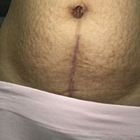 我的肚子啊~~剖腹产第三个月