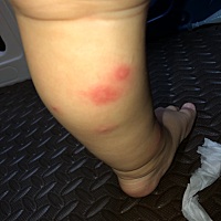 不知道被什么咬的，摸什么可以止痒