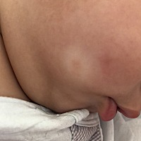 我家宝宝已经快6个月了，脸上这块湿疹都3、4个月了总是反反复复发出来，之前发出来我都给他擦些治疗湿疹...