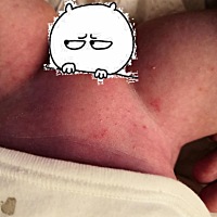 亲们，这样一点一点的是湿疹吗？