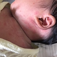 急求大神告知这是湿疹还是痱子？