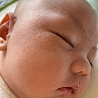 儿子脸上小疙瘩，有的说是湿疹，求高手支招！！