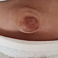 宝宝马上两个月了，但是肚脐眼还是这么突出，特别是哭闹的时候。另外老是放屁，涨红脸，还便秘，3或4天...