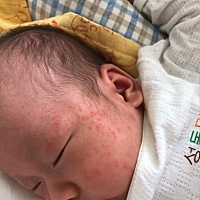 请问宝宝这脸上是痱子还是湿疹 身上没有 应该涂什么药膏吗