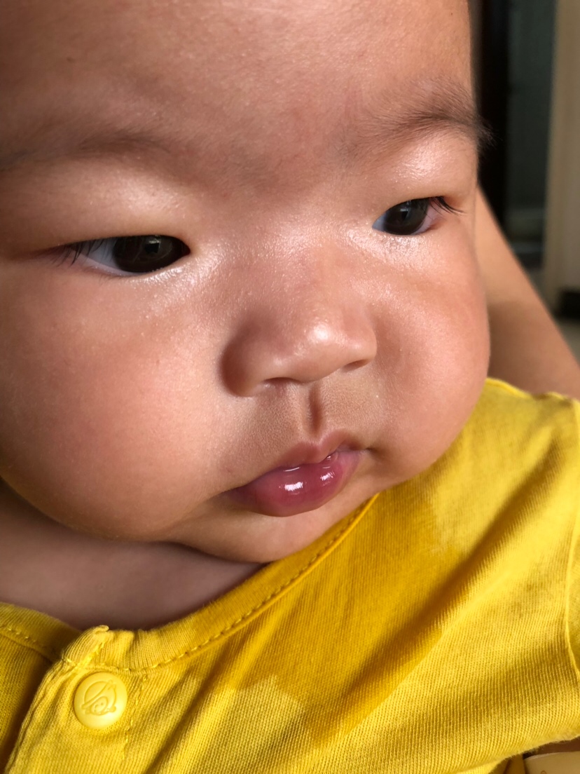 宝贝四个多月了，突然下嘴唇中间发紫，看到网上说的有可能是心脏的问题，吓都吓死了，不知道是不是真的，有必要走医院去检查看看吗？还是有可能是因为其它原因造成的...求给位宝妈们给点建议，是在家里观察看看，还是走医院去排查哈心脏方面的原因！