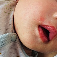 请教各位宝妈们，宝宝下巴嘴边是怎么回事？宝宝是怕热体质，这是热疹么？家里空调一直开着，只有清...