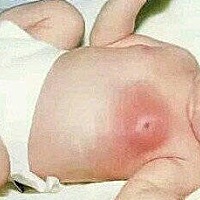 在宝宝出生二十天 婆婆就为了宝宝发育好，给孩子挤奶头！直到乳房发红才停手。到了晚上时，宝宝一直...