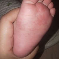 宝宝小脚起红疹子了。有谁知道这是什么疹子吗？放心不下。准备明天去医院检查一下。