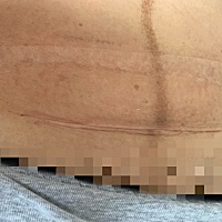 剖腹产第8天 刀口这样 算愈合了吗 还用在贴医用胶布吗？