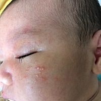 有同款疹子的宝妈吗？你们都怎么处理的呢？急