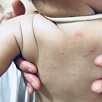 想问一下各位宝妈、这个是手足口吗？