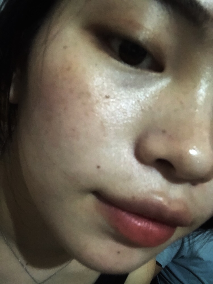 这是痘印和妊娠斑