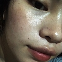 斑点痘痘痘印不容易啊 这是痘印和妊娠斑 怀孕长的 现在的我 产后三个月 苹果前置