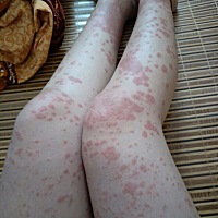 姐妹们 知道这是什么吗  好痒啊。大家帮我看看 出个解决方案吧 太痒了谢谢🙏