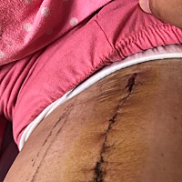 不敢擦药，怕自己给自己弄感染了，去医院又麻烦……哎，人啊，总是这么纠结