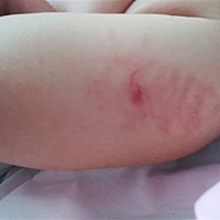 宝宝昨天打的预防针，今天起床就成这样了，，有知道怎么回事的亲吗？