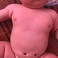 宝宝胳肢窝两边肉不一样多，腿纹也不对称，有懂的宝妈吗？