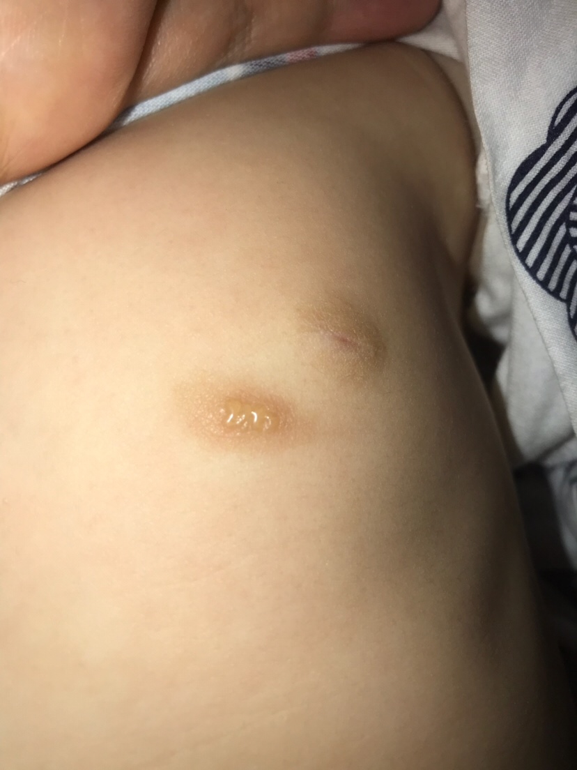 这块皮肤上昨天突然起水泡