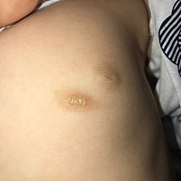 女儿快5个月，右胸口这个像红色胎记样的一块皮肤上突然起了几个水泡，并且像红色胎记样的皮肤时深时浅，...