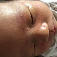 我家宝宝这两天长了很多这种白头疙瘩，头皮上都是，越来越多了。请问各位有经验宝妈这是什么痤疮还是湿...