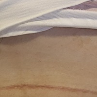 剖腹产70天，刀口有点红，不痛不痒。不知道是不是增生了。一般别人怎样的呢？有没有推荐好用有效果...