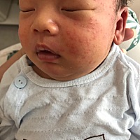 有宝妈知道这个湿疹怎么护理，用什么药好呢？