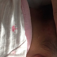 新生儿9天 不知道长得是什么 是血管瘤？