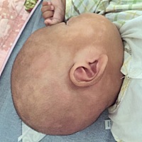 两个月宝宝脸上和头上一片一片白的，有宝妈知道是怎么回事吗？