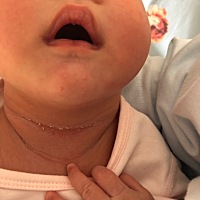 宝妈妈们 脖子被揽到了 用紫草油都没有用怎么办