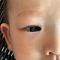 各位有应验的宝妈，孩子从出生眼尾内就多一块肉似的，我以为慢慢发育就会消失，可都6个月还是这么大，有...