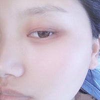 眼皮里长了一个疙瘩 不疼也不痒的 有谁知道怎么回事吗？