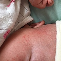 这是湿疹还是痱子？快一周了，现在脸上耳朵后脑勺都是，一热就很明显，空调温度开低点就好很多，大...