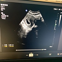 50天的b超，这就是小茄子么？